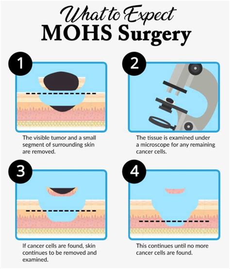 mohs micrographic surgery requires a.